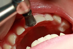 子どもの歯のクリーニング